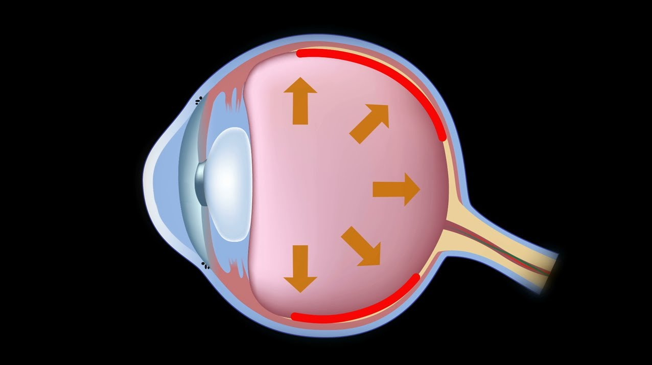 cataract care in karnal